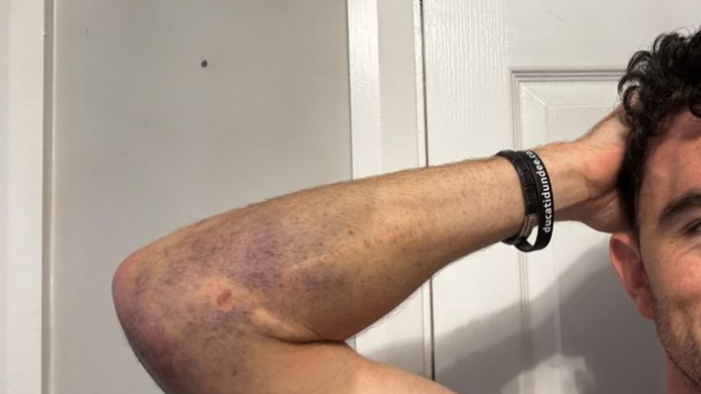 Glenn Irwin shows right arm bruising after Thruxton BSB high-side.